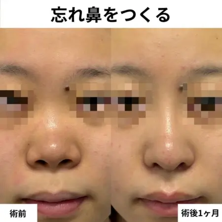 Before - 『鼻尖形成 』＋『鼻中隔延長』＋『鼻柱下降』＋『鼻翼縮小(内外) 』＋『プロテーゼ』