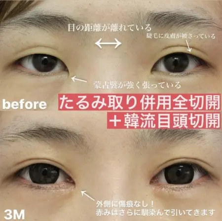 Before - 『たるみ取り併用全切開二重術 』＋『韓流目頭切開』