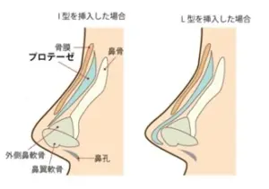 鼻整形プロテーゼ