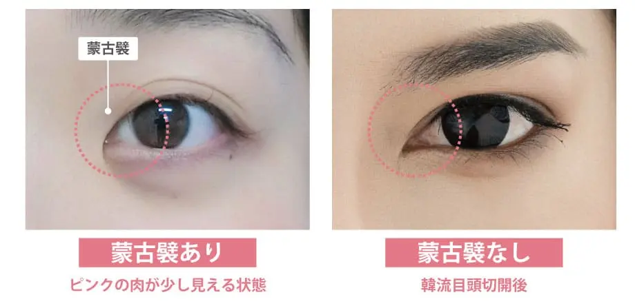 蒙古襞ありなし