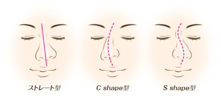 鼻のゆがみのパターンイメージ