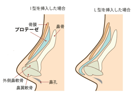 プロテーゼ 鼻の構造
