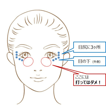 ボトックス治療の重要ポイント 若返り美容整形なら大阪のグローバルビューティークリニック