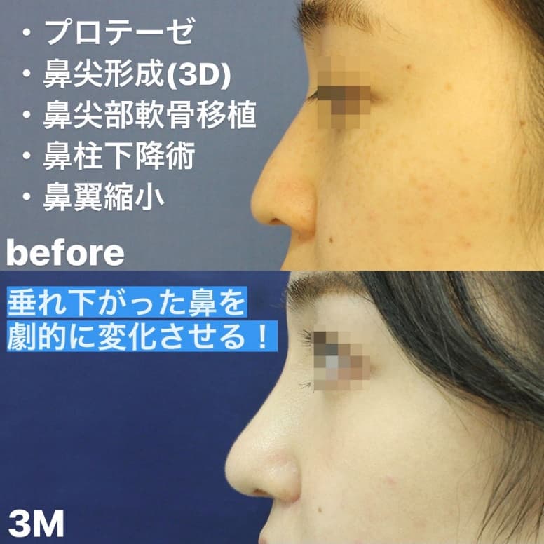 鼻の整形手術後 症例写真1