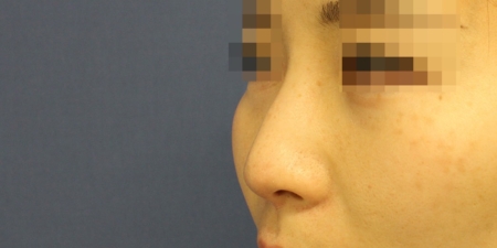 鼻尖形成術・鼻尖部軟骨移植・鼻翼縮小 術前写真2