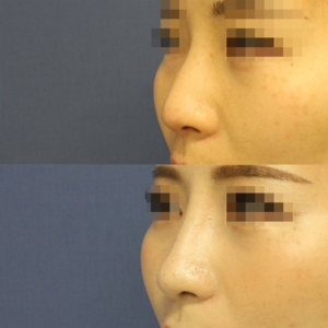 鼻尖形成術・鼻尖部軟骨移植・鼻翼縮小 症例