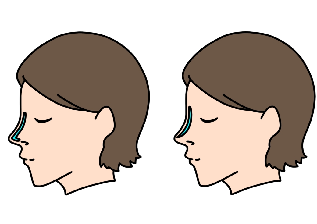 鼻プロテーゼI型L型