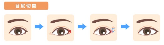 目の整形の種類