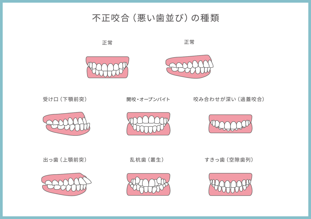 歯並びのイメージ