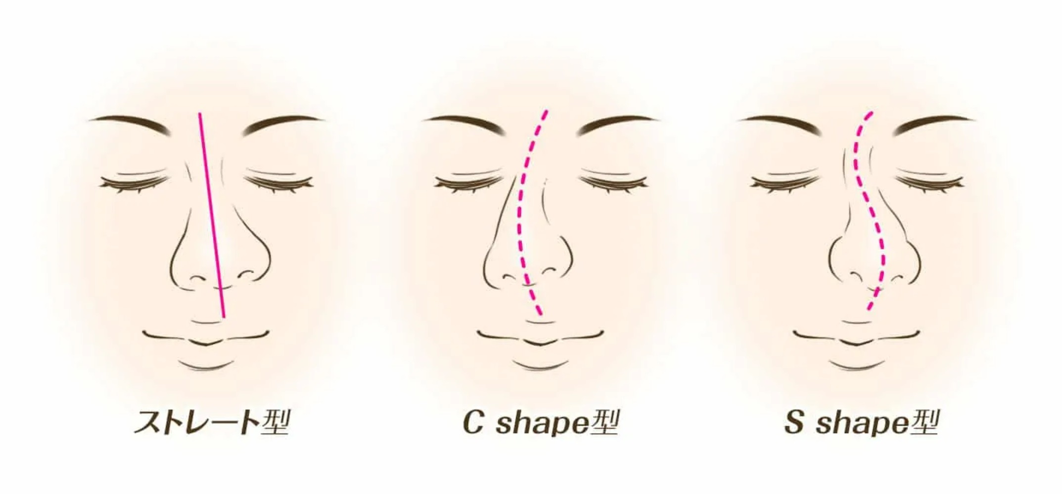 鼻の歪みを自力で治すリスクとは？斜鼻修正術のメリット・注意点を詳しく紹介します！