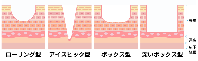 tca 安い ピーリング 100